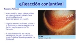 3.Reacción conjuntival Reacción Folicular 
Reacción Folicular 
 
Composición: focos subepiteliales 
de hiperplasia del tejid