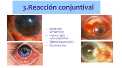 3.Reacción conjuntival 
– Inyección 
conjuntival 
– Hemorragia 
subconjuntival 
– Edema (quemosis) 
– Cicatrización 
