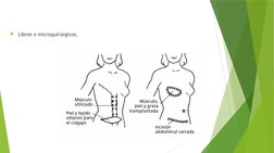 Libres o microquirúrgicos.
