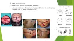 2. Según su movimiento 
- Locales (zona dadora adyacente al defecto):
    a. Avance: se mueve directamente hacia el defecto,