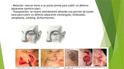 - Rotación: rota en torno a un punto pivote para cubrir un defecto
adyacente (semicircular).
- Transposición: se mueve latera