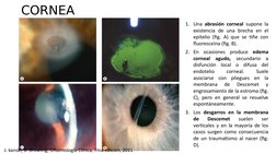 CORNEA
1. Una abrasión corneal supone la 
existencia de una brecha en el 
epitelio (fig. A) que se tiñe con 
fluoresceína (fi