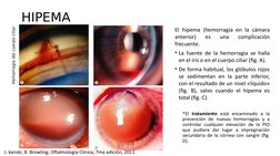 HIPEMA
El hipema (hemorragia en la cámara 
anterior) 
es 
una 
complicación 
frecuente.
• La fuente de la hemorragia se halla