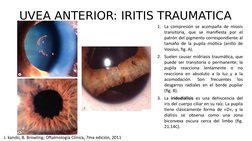 UVEA ANTERIOR: IRITIS TRAUMATICA
1. La compresión se acompaña de miosis 
transitoria, que se manifiesta por el 
patrón del pi