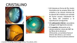 CRISTALINO
• (A) Catarata en forma de flor; lesión 
traumática de las propias fibras del 
cristalino y las roturas mínimas de