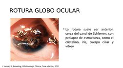 ROTURA GLOBO OCULAR
• La rotura suele ser anterior, 
cerca del canal de Schlemm, con 
prolapso de estructuras, como el 
crist