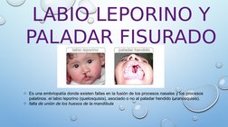 LABIO LEPORINO Y 
PALADAR FISURADO 
o Es una embriopatía donde existen fallas en la fusión de los procesos nasales y los proc