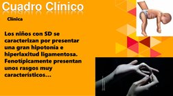 Cuadro Clínico
Clínica
Los niños con SD se 
caracterizan por presentar 
una gran hipotonía e 
hiperlaxitud ligamentosa. 
Feno