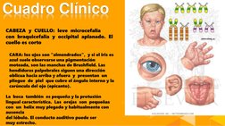 Cuadro Clínico
CABEZA  y  CUELLO:  leve  microcefalia
con  braquicefalia  y  occipital  aplanado.  El 
cuello es corto
CARA: