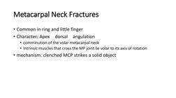 Metacarpal Neck Fractures
• Common in ring and little finger 
• Character: Apex
dorsal
angulation 
• comminution of the volar