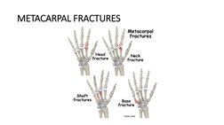 METACARPAL FRACTURES
