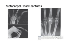 Metacarpal Head Fractures
