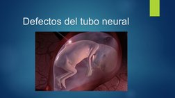 Defectos del tubo neural
