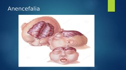 Anencefalia
