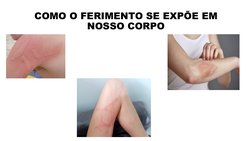 COMO O FERIMENTO SE EXPÕE EM 
NOSSO CORPO

