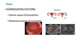 Subinvolution Def Understanding Uterine Subinvolution | PDF | Postpartum Period | Midwifery