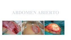 ABDOMEN ABIERTO
