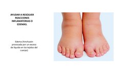 AYUDAR A RESOLVER 
REACCIONES 
INFLAMATORIAS O 
EDEMAS.
Edema (hinchazón 
provocada por un exceso 
de líquido en los tejidos