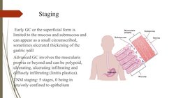 Staging
 Early GC or the superficial form is 
limited to the mucosa and submucosa and 
can appear as a small circumscribed,