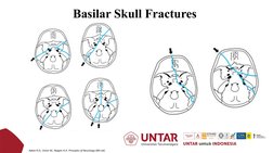 Basilar Skull Fractures 
Adam R.D., Victor M., Ropper A.H. Principles of Neurology (8th ed).
