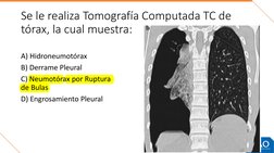 Se le realiza Tomografía Computada TC de 
tórax, la cual muestra:
A) Hidroneumotórax 
B) Derrame Pleural
C) Neumotórax por Ru
