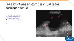 Las estructuras anatómicas visualizadas 
corresponden a:
a) ……………………….
b) ……………………….
c) ……………………….
PULMÓN COLAPSADO
DERRAME P