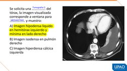 Se solicita una ……………. del 
tórax, la imagen visualizada 
corresponde a ventana para 
……………… y muestra:
A) Imagen hipodensa l