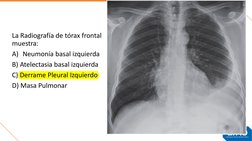 La Radiografía de tórax frontal 
muestra:
A) Neumonía basal izquierda
B) Atelectasia basal izquierda
C) Derrame Pleural Izqui