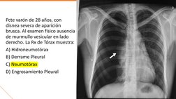 Pcte varón de 28 años, con 
disnea severa de aparición 
brusca. Al examen físico ausencia 
de murmullo vesicular en lado 
der