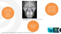 Ricketts R. Grummons D. Frontal Cephalometrics: Practical Applications, Part I. World J Orthod. 2003;4:297–316.  
https://sol