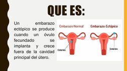 QUE ES:
Un 
embarazo 
ectópico se produce 
cuando 
un 
óvulo 
fecundado 
se 
implanta 
y 
crece 
fuera de la cavidad 
princip