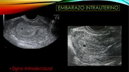 EMBARAZO INTRAUTERINO
• Signo intradecidual

