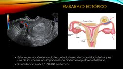 • Es la implantación del ovulo fecundado fuera de la cavidad uterina y es
una de las causas mas importantes de abdomen agudo