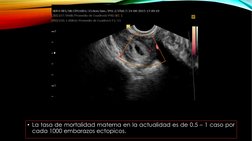 • La tasa de mortalidad materna en la actualidad es de 0.5 – 1 caso por
cada 1000 embarazos ectopicos.
