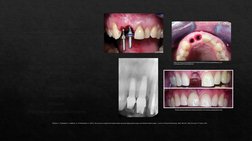 La posición óptima del implante 
es un factor de importancia 
crítica para el ÉXITO a largo 
plazo de la terapia con implante