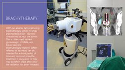 BRACHYTHERAPY
IGRT can also be delivered using 
brachytherapy, which involves 
placing radioactive  sources 
directly into or