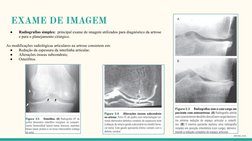 EXAME DE IMAGEM
●
Radiografias simples:  principal exame de imagem utilizados para diagnóstico da artrose 
e para o planejame