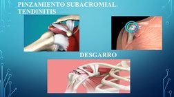 PINZAMIENTO SUBACROMIAL.             
TENDINITIS
DESGARRO
