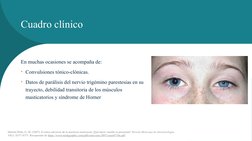 Cuadro clínico
En muchas ocasiones se acompaña de: 
• Convulsiones tónico-clónicas. 
• Datos de parálisis del nervio trigémin