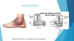 DIAGNOSTICO
Rockwood and Green´s, Quinta Edición. Fracturas de tobillo
