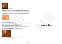 A & W
111
Exsudato mole (algodonoso)
FONTE: Gerstenblith, Adam T., Rabinowitz, Michael P. Manual de Doenças Oculares do Wills