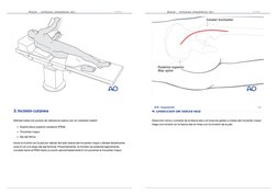 3. Incisión cutánea
Delinee todos los puntos de referencia óseos con un rotulador estéril:
Espina iliaca superior posterior (