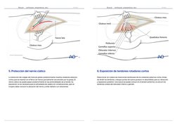 5. Protección del nervio ciático
La retracción del colgajo del músculo glúteo posteriormente muestra rotadores externos
corto