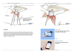 9. Cierre
Al finalizar el procedimiento, las suturas del colgajo capsular posterior y luego las suturas
del tendón se unen en