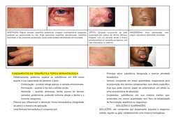 VEGETAÇÃO: Pápula elevada, superfície endurecida, irregular, eventualmente sangrante,
podendo ser pedunculada ou não. Pode ap