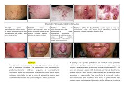 GRAUS OU FORMAS CLÍNICAS DE ROSÁCEA
ROSÁCEA
GRAU
I
(ERITÊMATO-TELANGIECTÁSIA):
há eritema persistente com ou sem
telangiectas