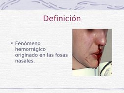  
 
Definición
• Fenómeno 
hemorrágico 
originado en las fosas 
nasales.
