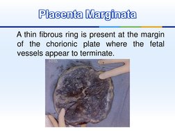 Chorionic Ring Placenta and Cord Abnormalities Overview | PDF | Placenta | Fetus