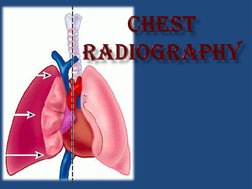 Lordotic and Apicogram Chest X-Ray Guide | PDF | Lung | Thorax