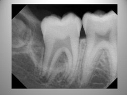 Normal Bone Level Radiograph Interpreting Dental Radiographs | PDF | Dentistry | Mouth